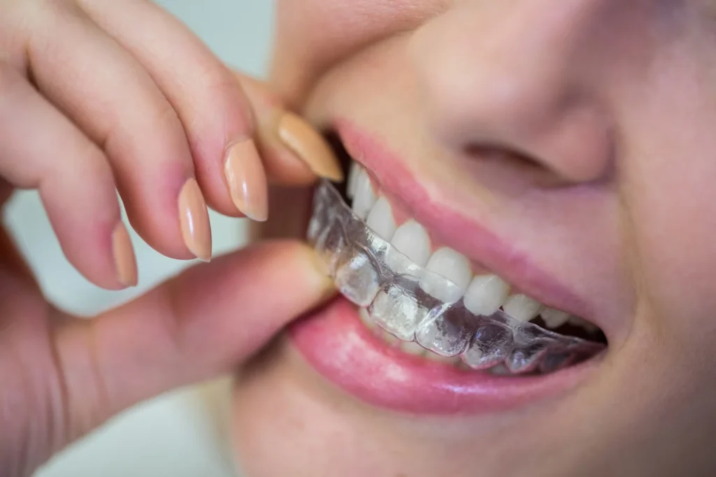 Choosing Between Invisalign and Braces