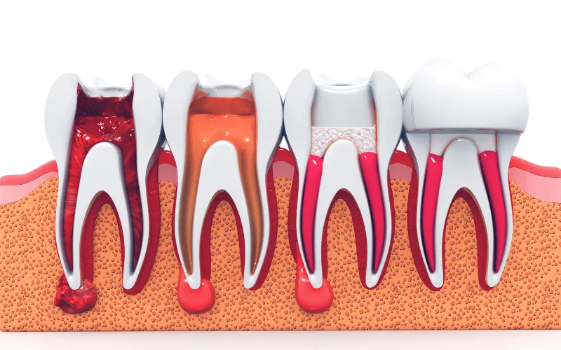 Everything You Need to Know About Root Canals