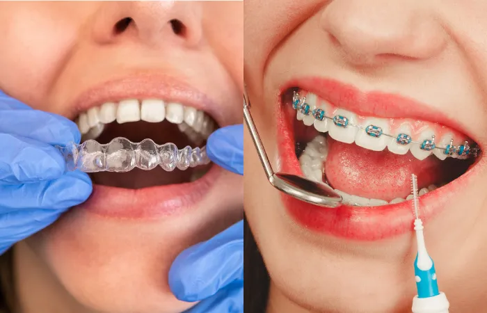 How Invisalign is Revolutionizing Orthodontic Treatment