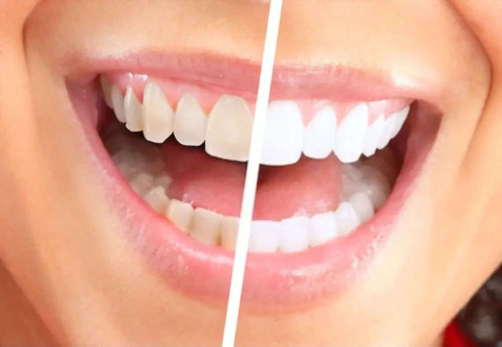 Methods for Professional Teeth Whitening