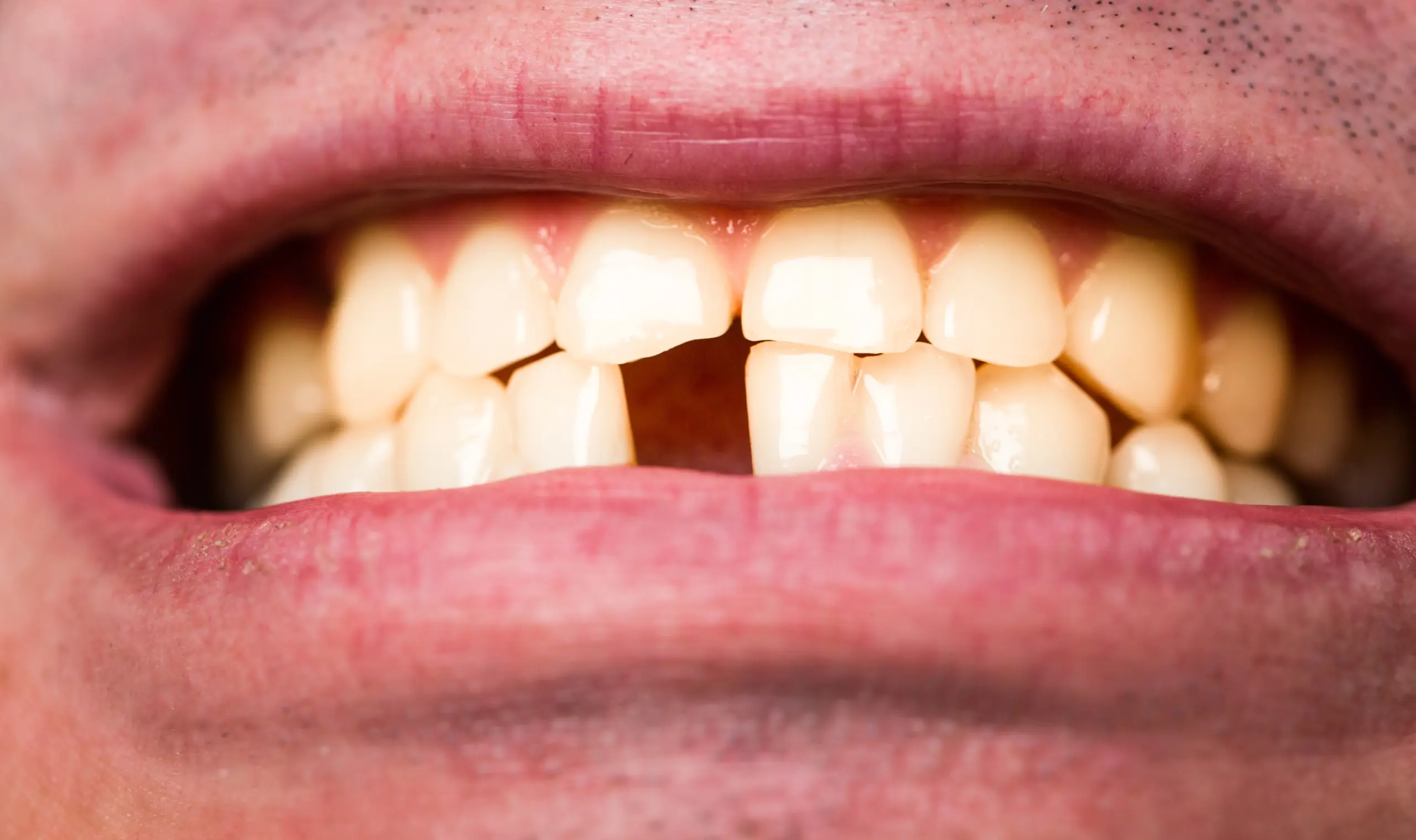 Understanding Tooth Decay and How To Treat It