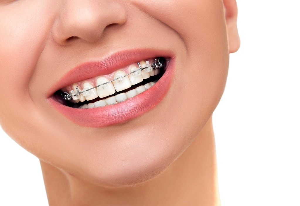Are Braces for Adults?
