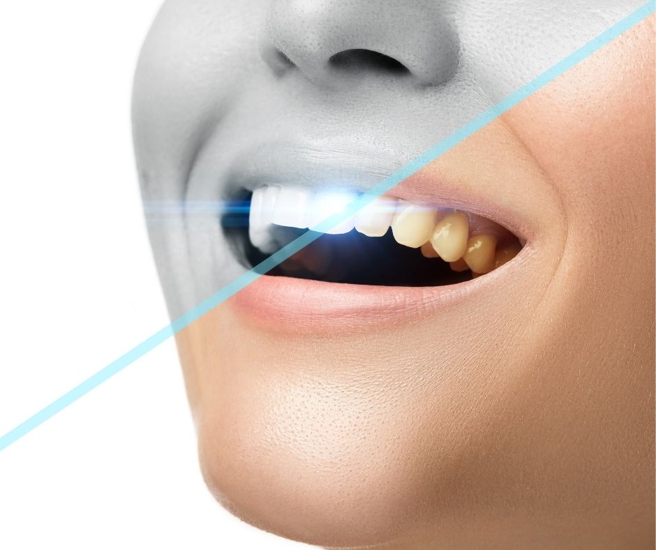 What You Need To Know About Professional Teeth Whitening