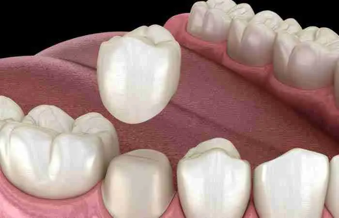 Three Types of Dental Restoration Services