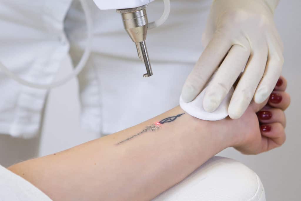 The Role of Aftercare in Successful Tattoo Removal