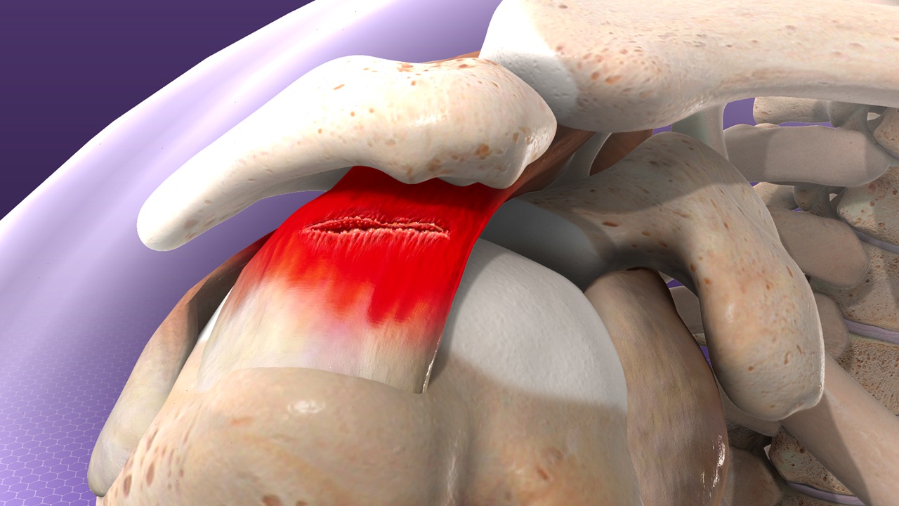 What You Should Know When Recovering From Rotator Cuff Tears