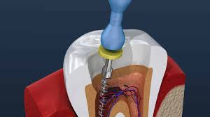Exploring the Advantages of Endodontic Implants for Tooth Restoration