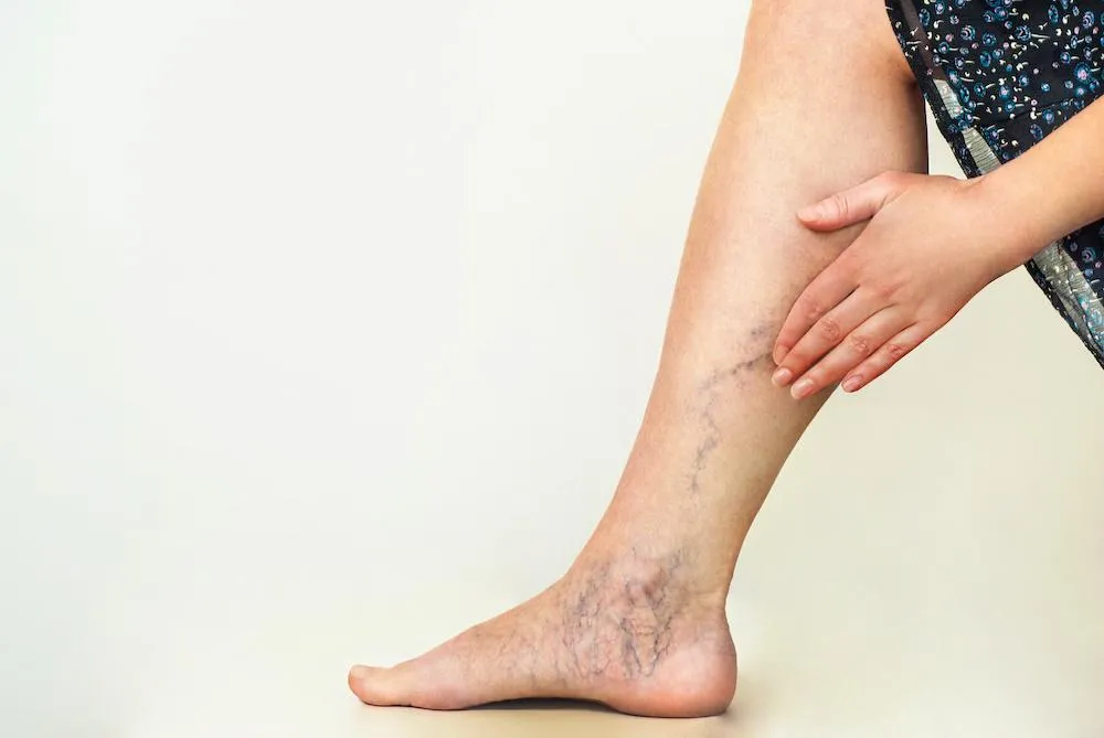 Home Remedies and Lifestyle Changes for Varicose Veins