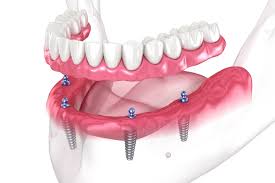 How a Dental Implant Specialist Can Restore Your Confidence