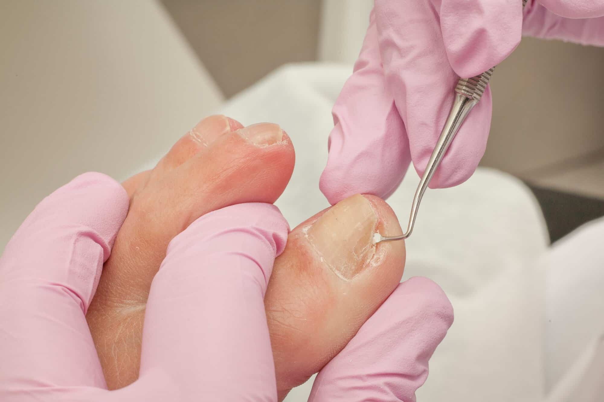 Surgical Options for Severe Ingrown Toenails