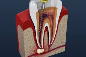 The Role of Root Canals in Saving Natural Teeth