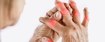 When do Arthritis Symptoms Become Serious?